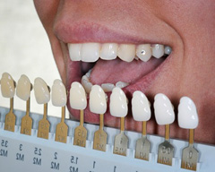 Выравнивание зубов винирами