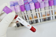 Что такое HBsAg и о чем говорят результаты анализа крови на антиген?