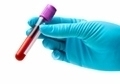 Тромбоциты в крови: норма, причины повышенного и пониженного уровня