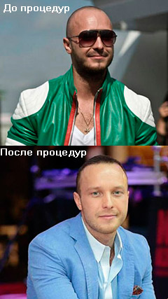 Безоперационная трансплантация