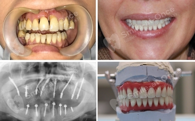 протезирование