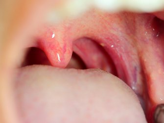 Чем лечить больное горло?