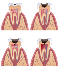 Какая часть зуба поражается при возникновении кариеса