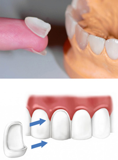 Новинки в стоматологии протезирование зубы