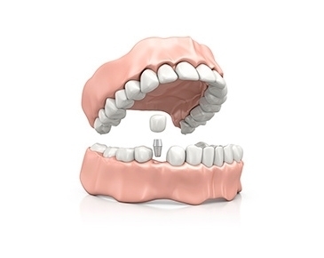Противопоказания при базальной имплантации зубов thumbnail