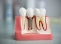 Чем отличается протезирование зубов all-on-4 и all-on-6 от базальной имплантации