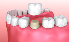 Зубные коронки металлические или керамические