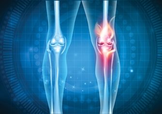 deformirana artroza liječenja zgloba koljena injekcije za bol u zglobovima prstiju