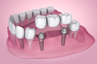 Услуги по имплантации зубов
