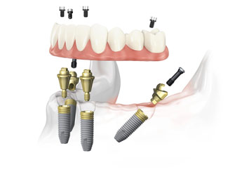 Установка зубных протезов при полном отсутствии зубов