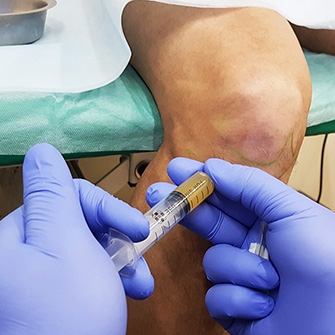 liječenje artroze koljena plazmoliftingom