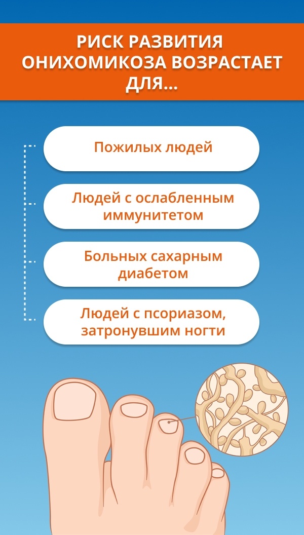 Как вылечить грибок на ногах: народные средства - Областная газета чайкоффъ.рф