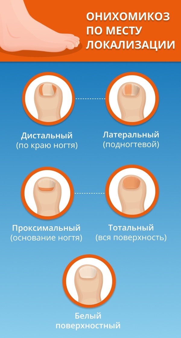 Онихомикоз: признаки, причины возникновения и методы лечения онихомикоза