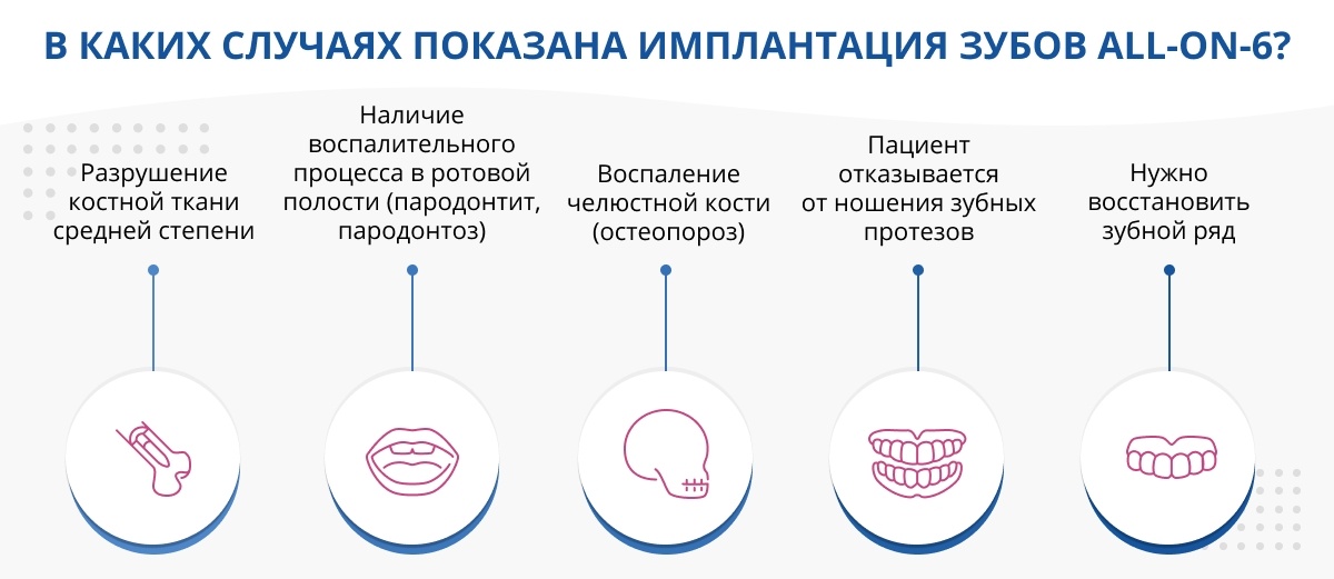 В каких случаях показана имплантация зубов all-on-6?