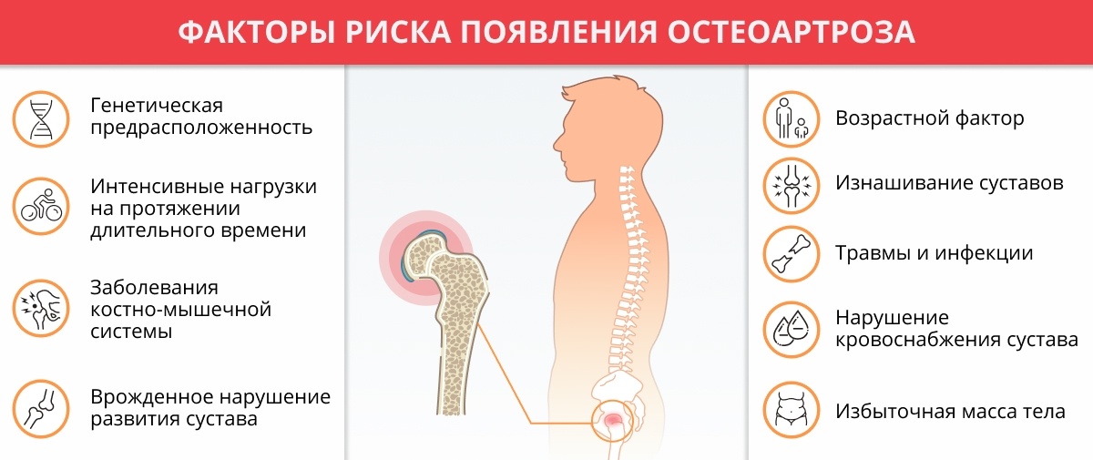 Факторы риска появления остеоартроза