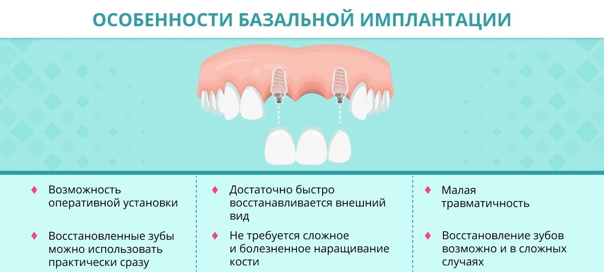 Имплант зуба тамбов