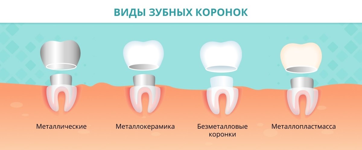Как долго могут служить зубные коронки
