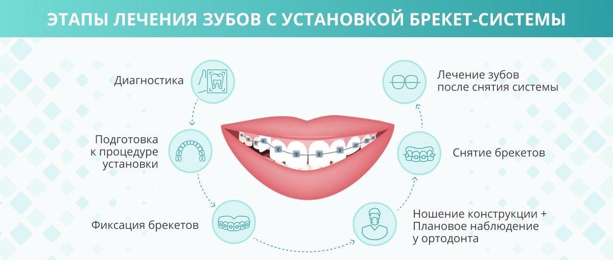 Этапы лечения зубов с установкой брекет-системы