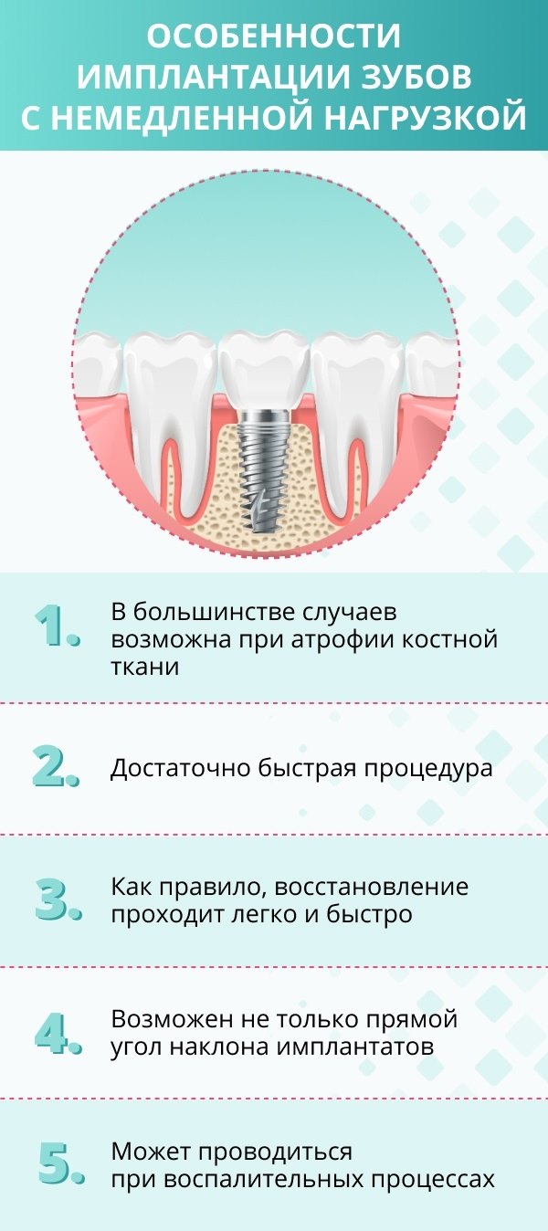 Immediate Load – современный способ имплантации с немедленной нагрузкой в  стоматологиях Москвы