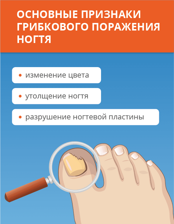 Лечение онихомикоза. Лечение грибка ногтей народными способами в домашних условиях