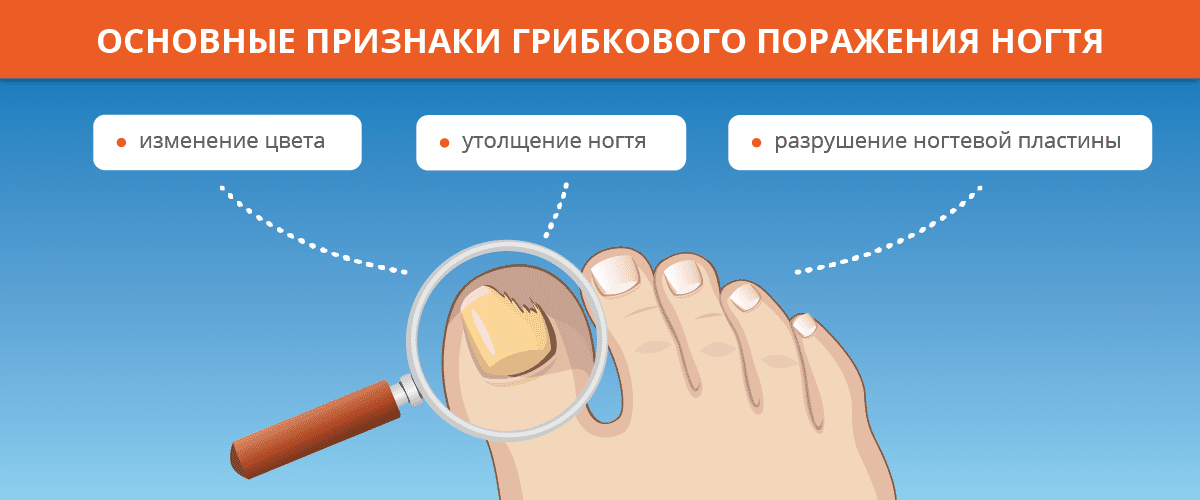 Основные признаки грибкового поражения ногтя