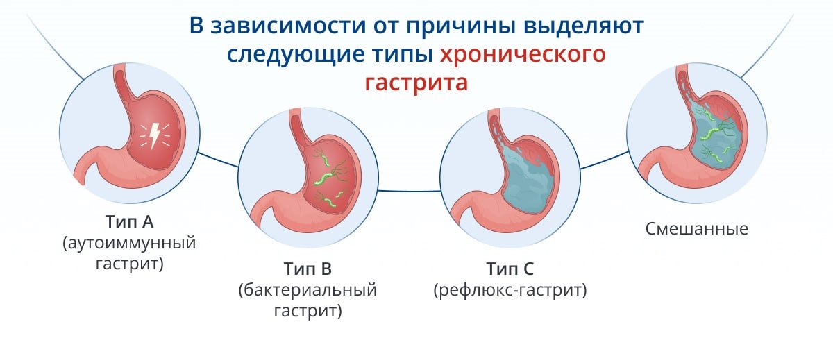 Лечение гастрита желудка препараты схема лечения с повышенной кислотностью