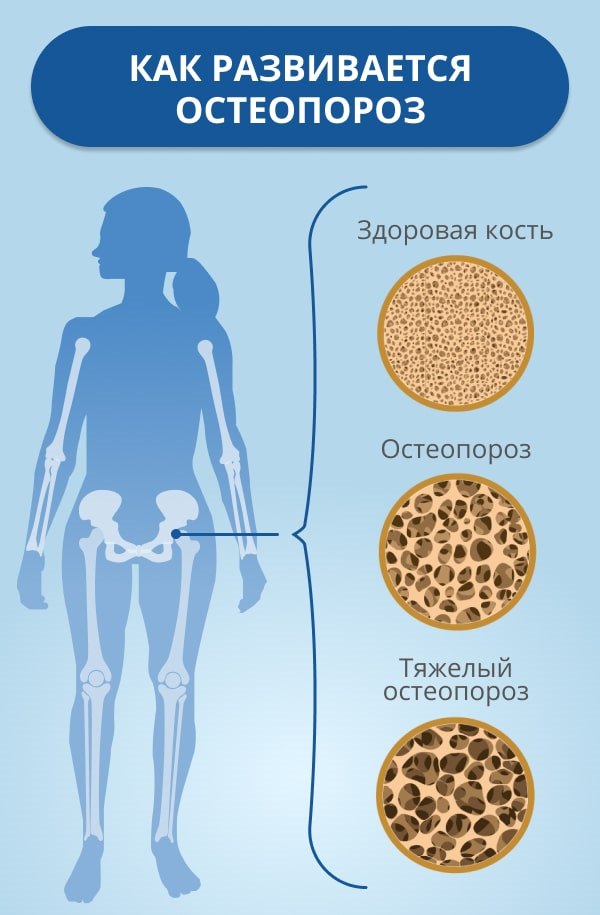 Остеопороз костей и позвоночника: диагностика, лечение
