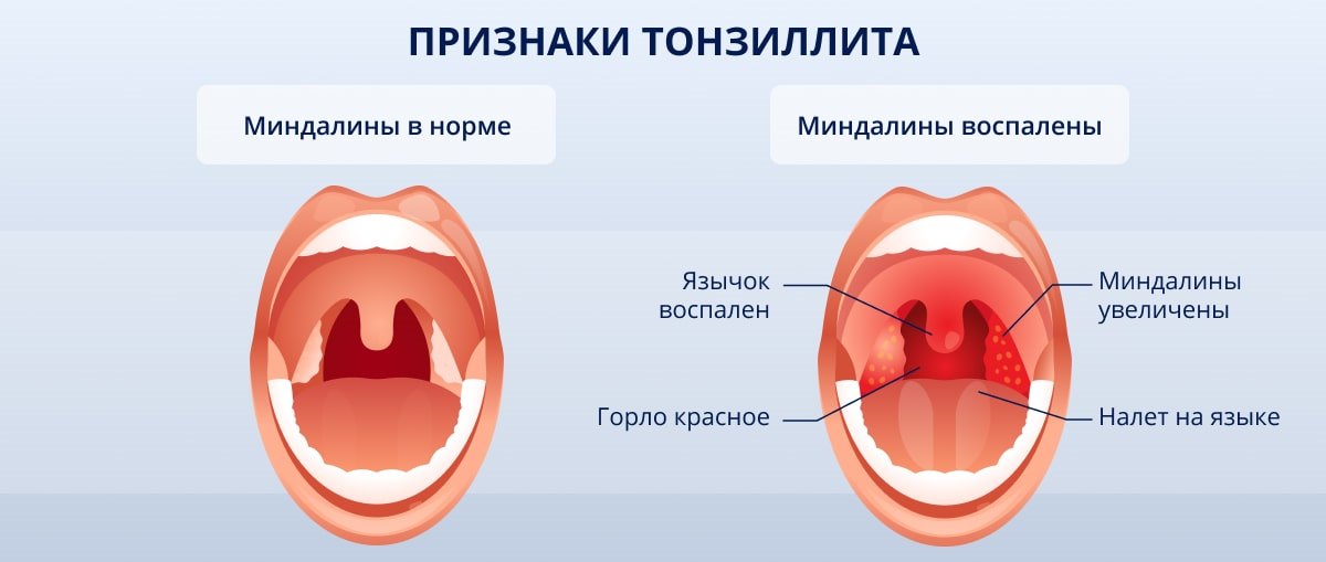 Тонзиллит: симптомы, причины, диагностика и лечение | Блог ЛДЦ Здоровье