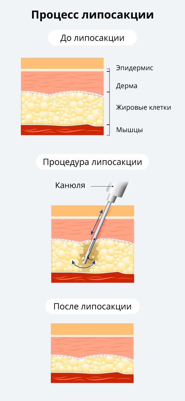 Липосакция лица