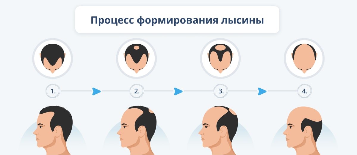 11 причин выпадения волос у мужчин