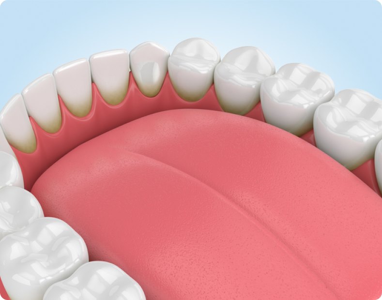 Зубной камень — что это и как с ним бороться?