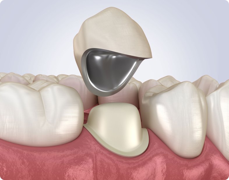Коронки на зубы металлокерамика фото