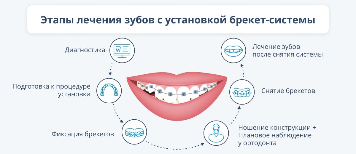 Этапы лечения зубов с установкой брекет-системы