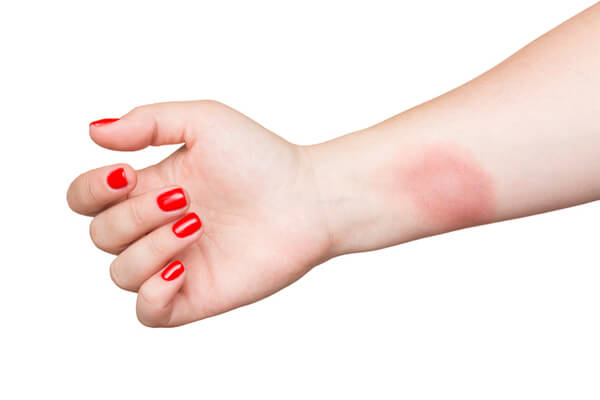 Разновидности ожогов кожи - эффективное лечение | Бепантен®
