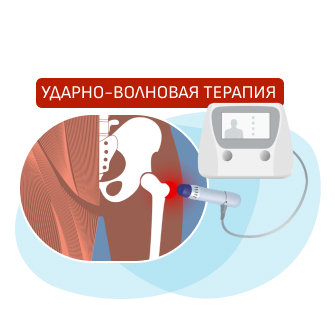 Ударно волновая терапия карта