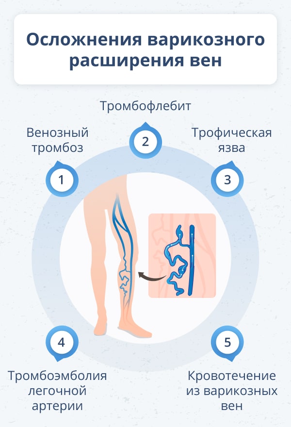 Что делать, если жжёт вены на ноге?