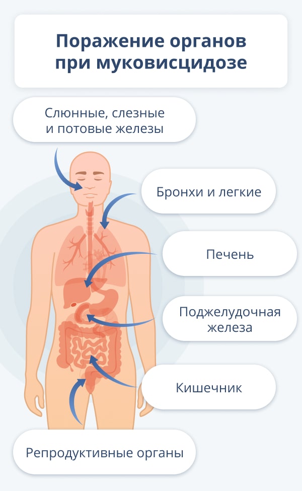 Муковисцидоз кишечная форма форум